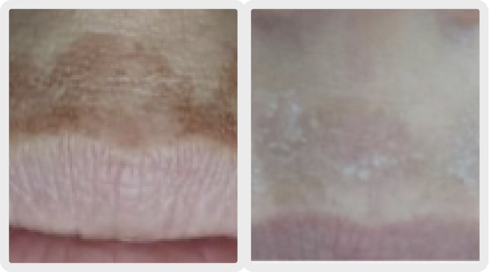 Before and after melasma