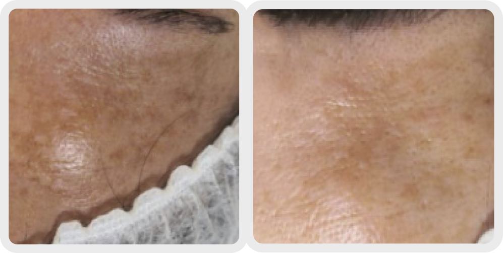 Before and after pigmentation