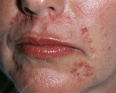 Rosacea redness page