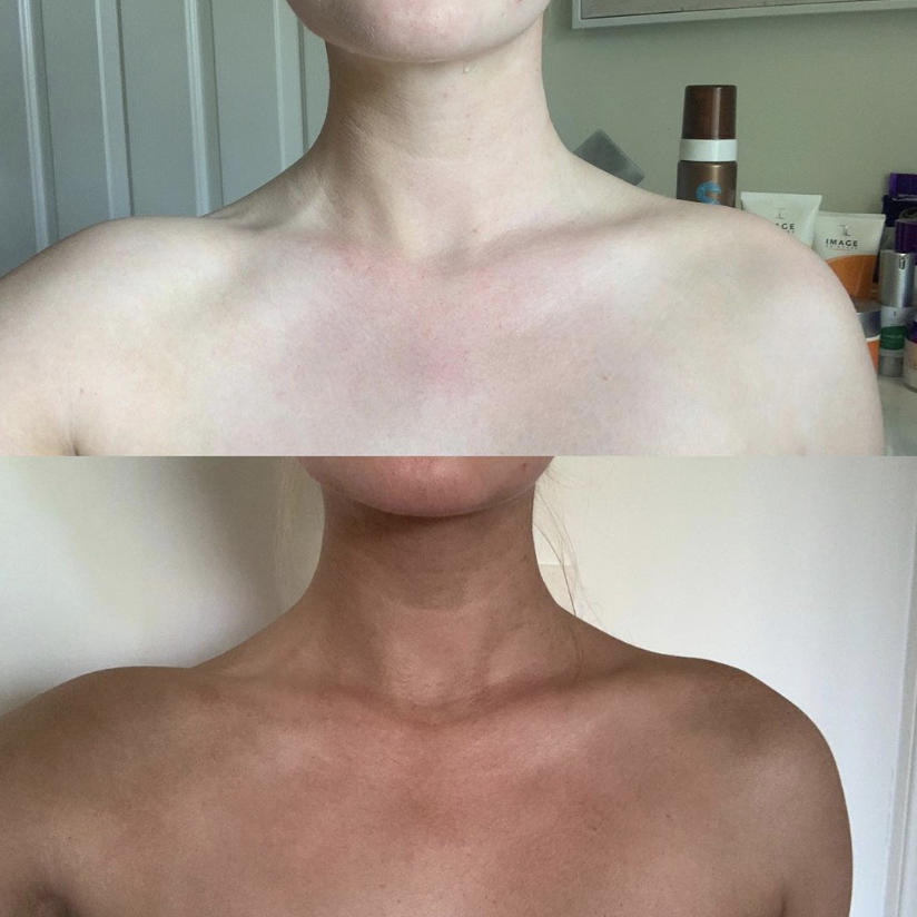 Before and after Sunescape spray tan - chest