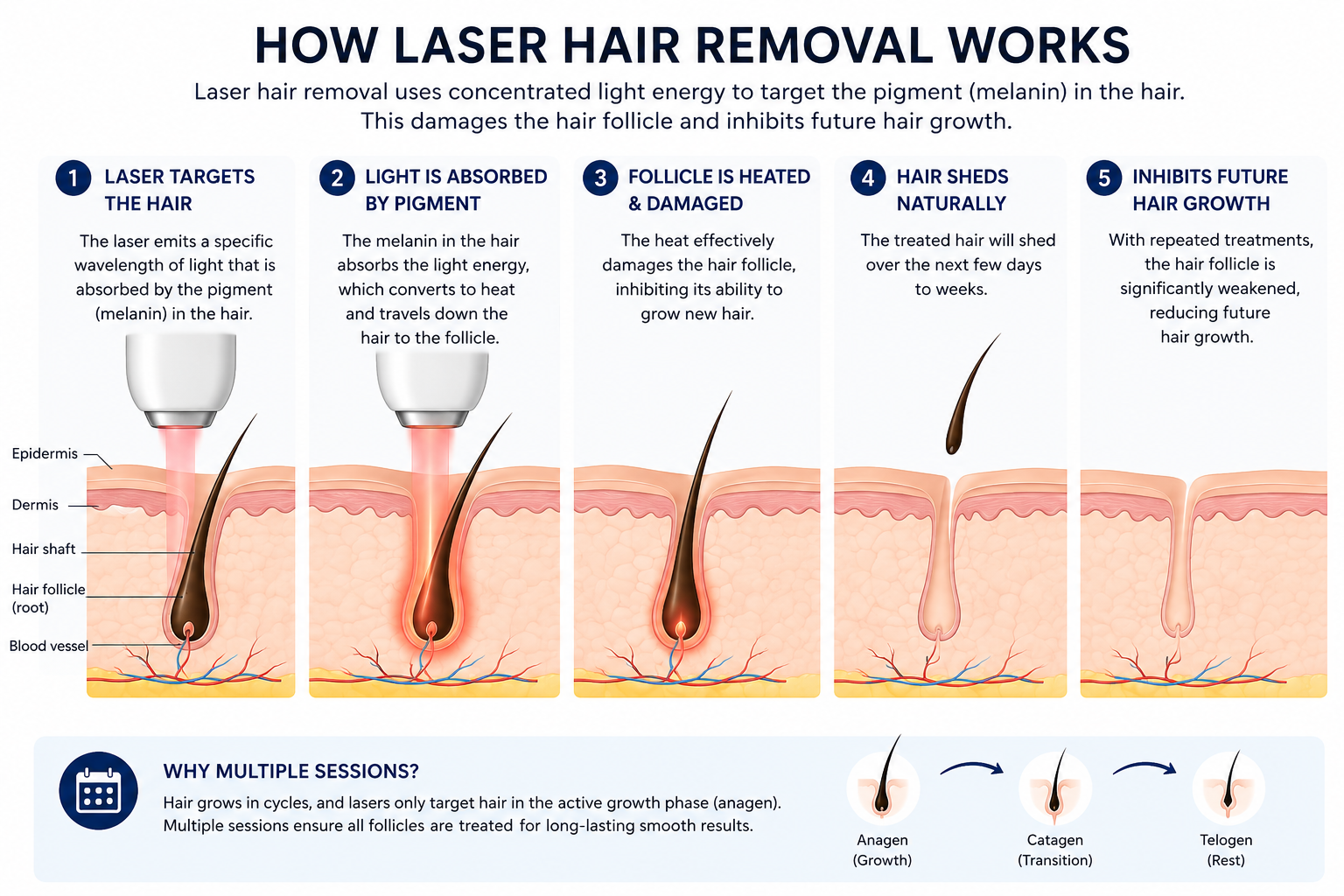 Infographic: How laser hair removal works, from targeting the follicle to inhibiting future growth