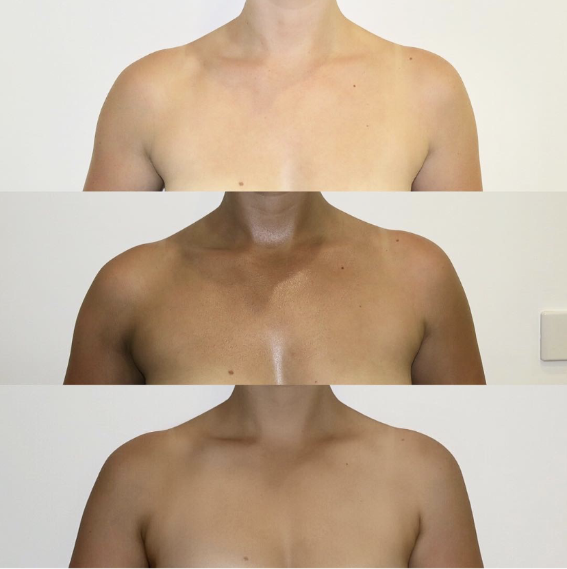 Sunescape tan progression on chest